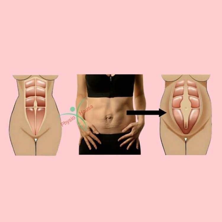 Buɗewar Murfin Ciki Bayan Haihuwa: Sababi,  Da Maganinsa