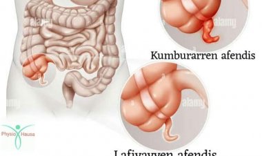 Ciwon Afendis: Abubuwa 10 da ya kamata ka sani game da shi